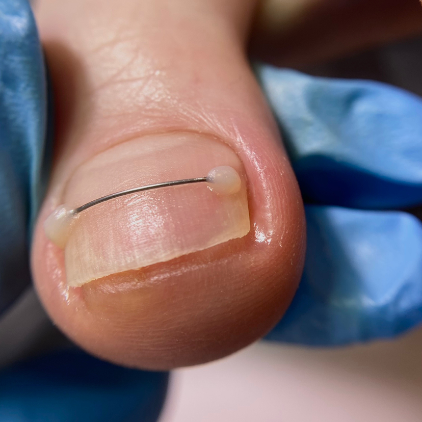 Коррекция вросших ногтей