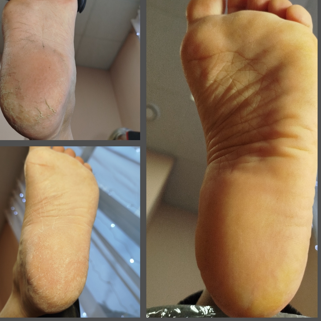 обработка трещин/мозолей