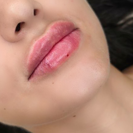 Аугментация губ Sardenya deep 1ml
