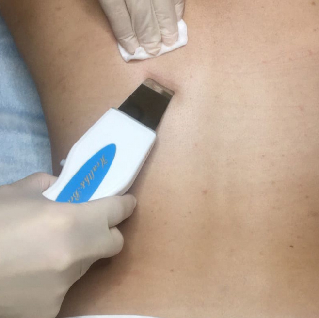 Чистка спины