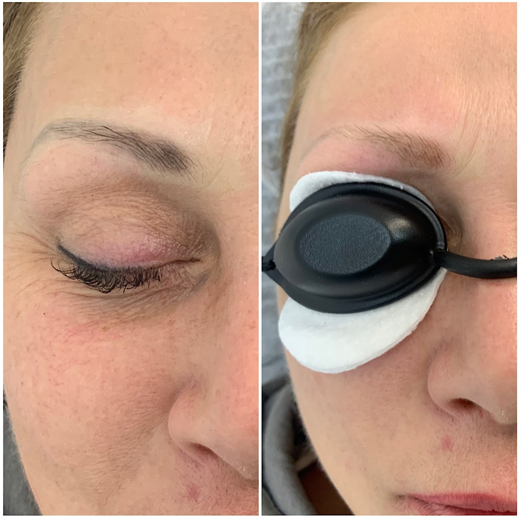 Удаления перманентного макияжа