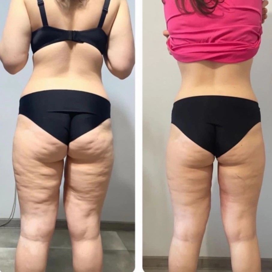 Антицеллюлитный массаж Лепка