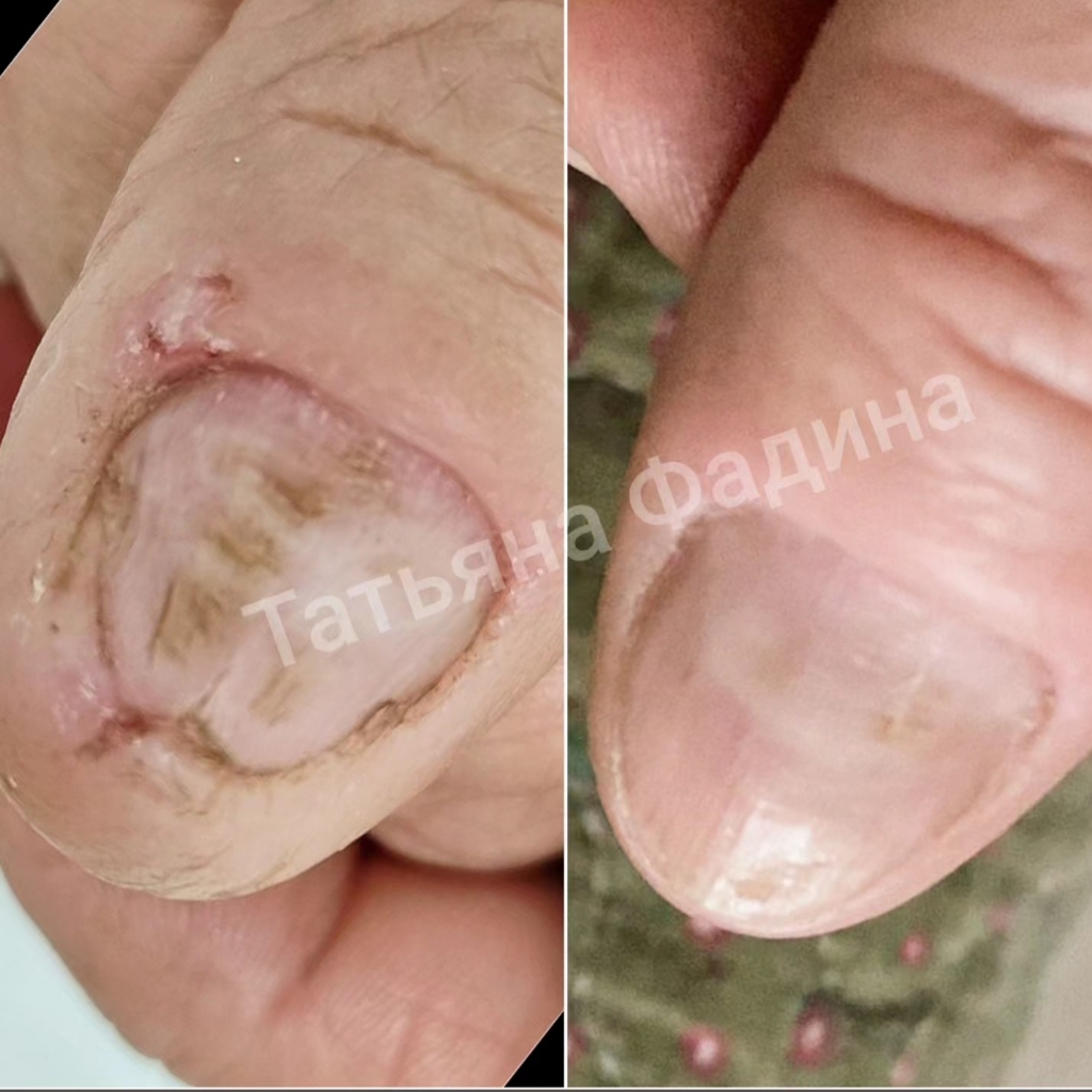Восстановление ногтевой пластины ХП