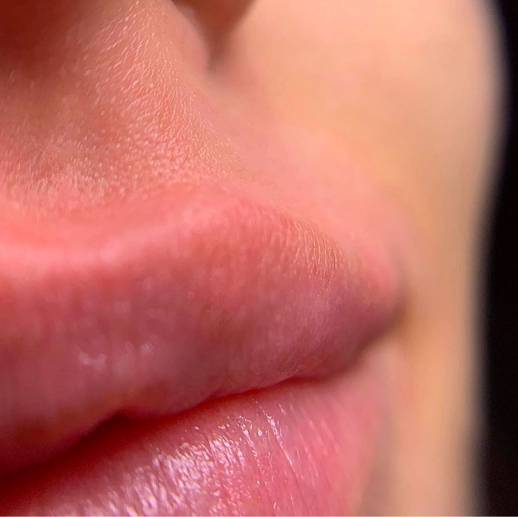 Удаление пушка на лице