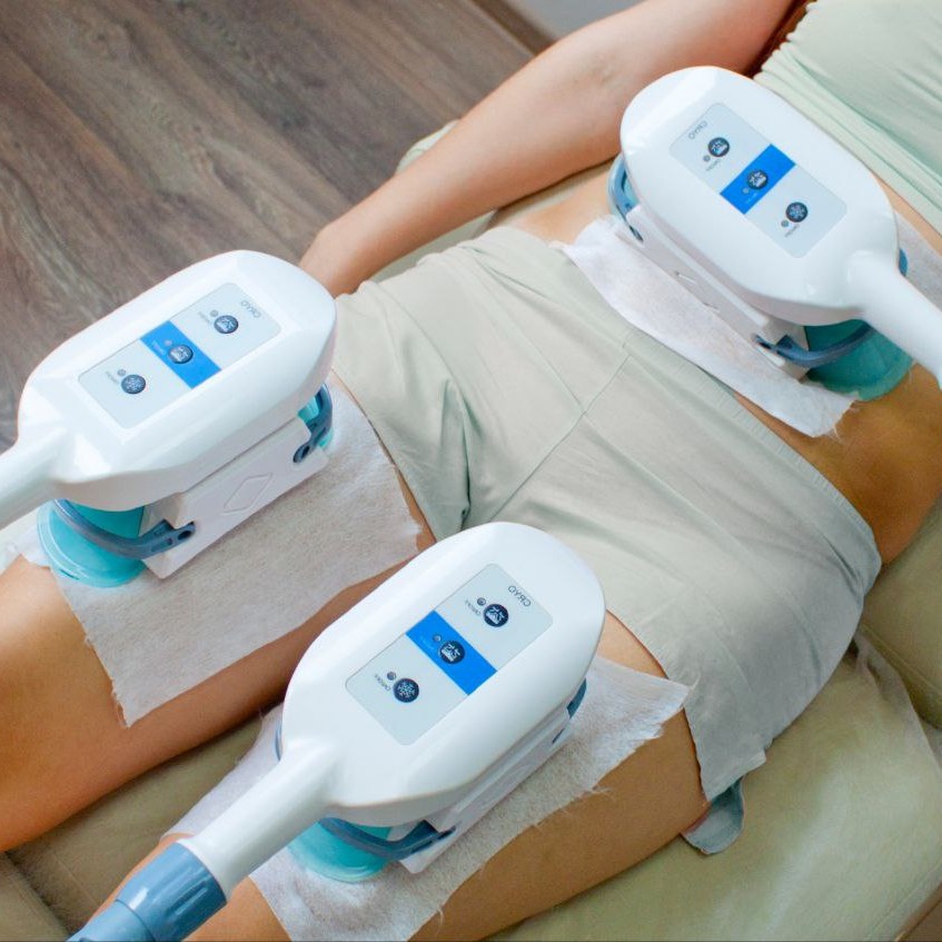 Криолиполиз 3 зоны