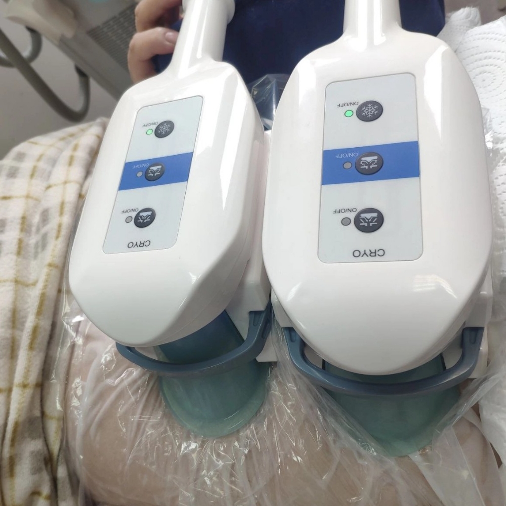 Криолиполиз 2 зоны