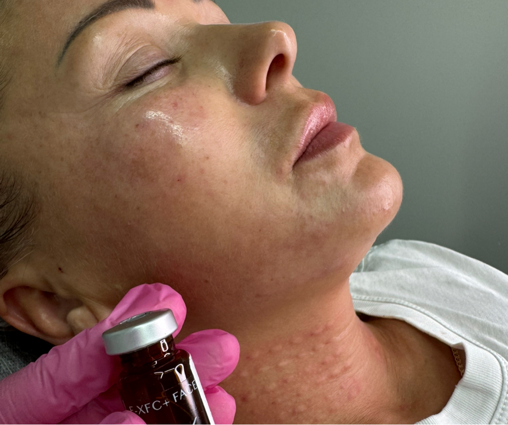 Мезотерапия лица Fusion Mesotherapy