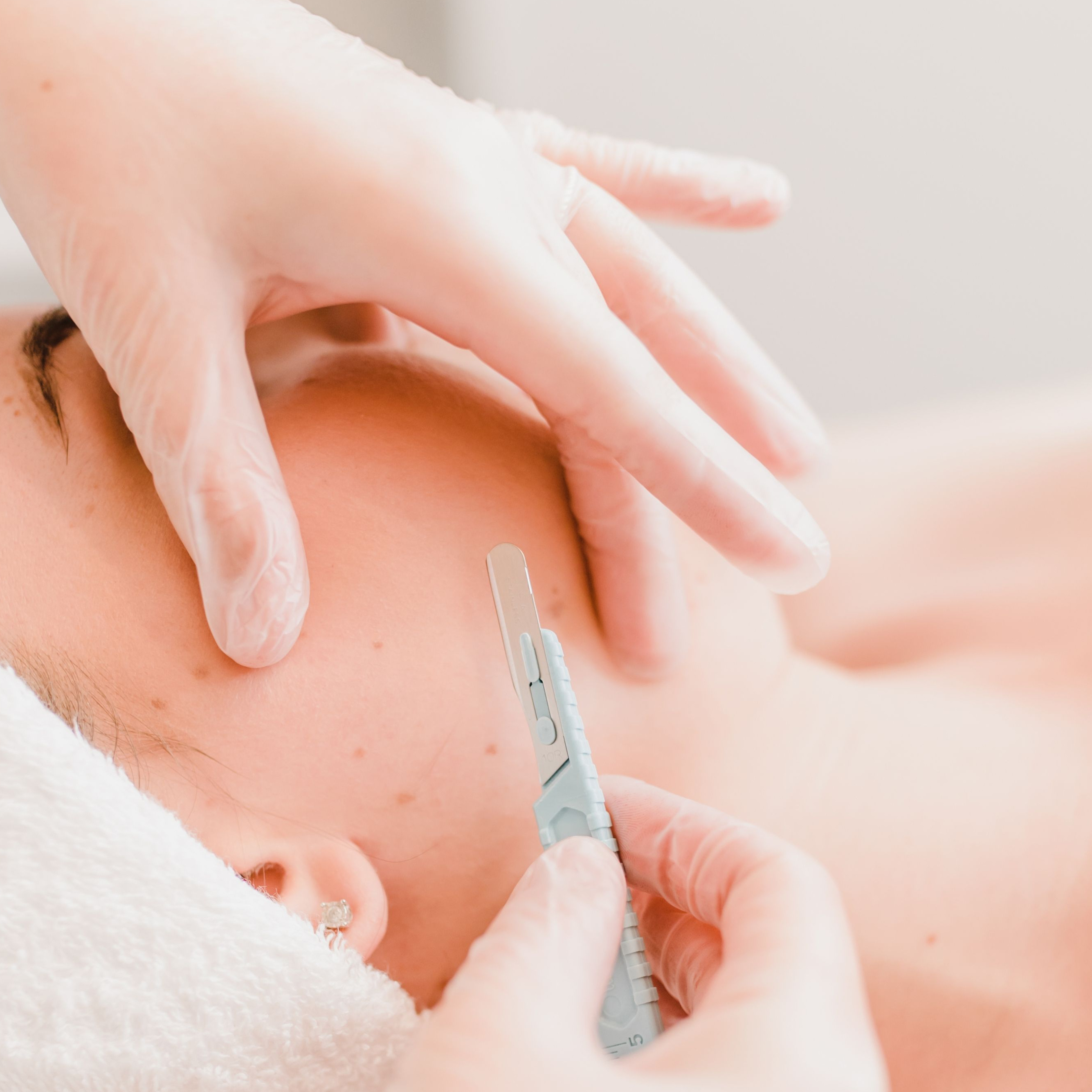 Dermaplaning