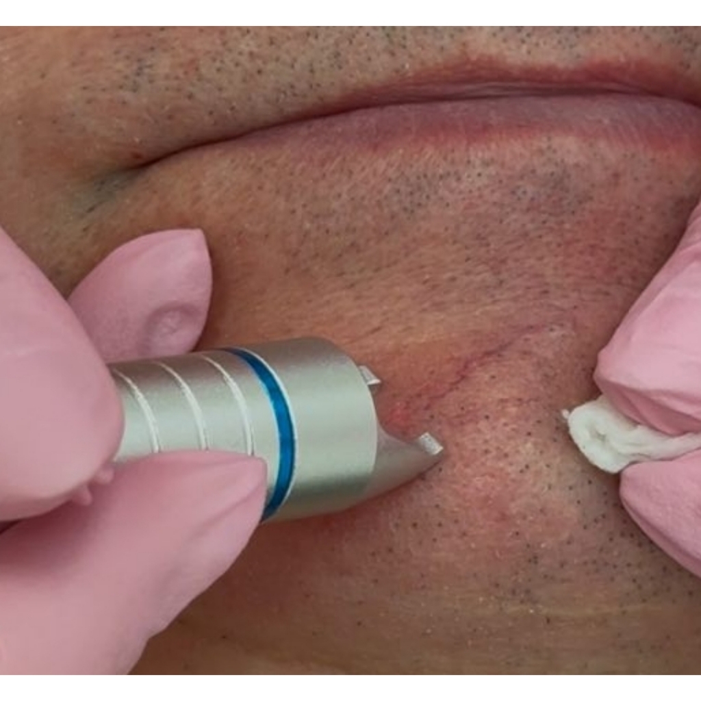 Удаление кровеносных сосудов G-medical