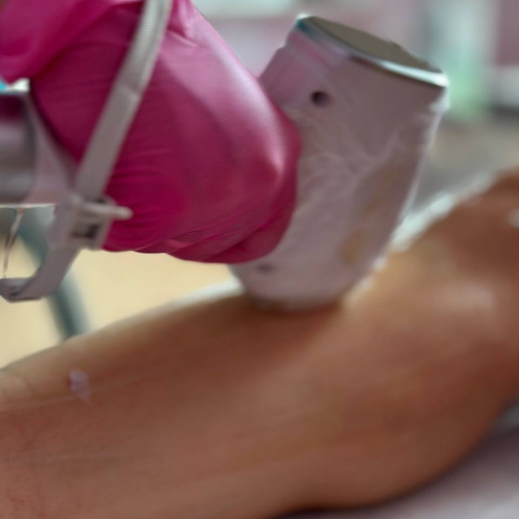 Лазерная эпиляция зоны рук до/после локтя