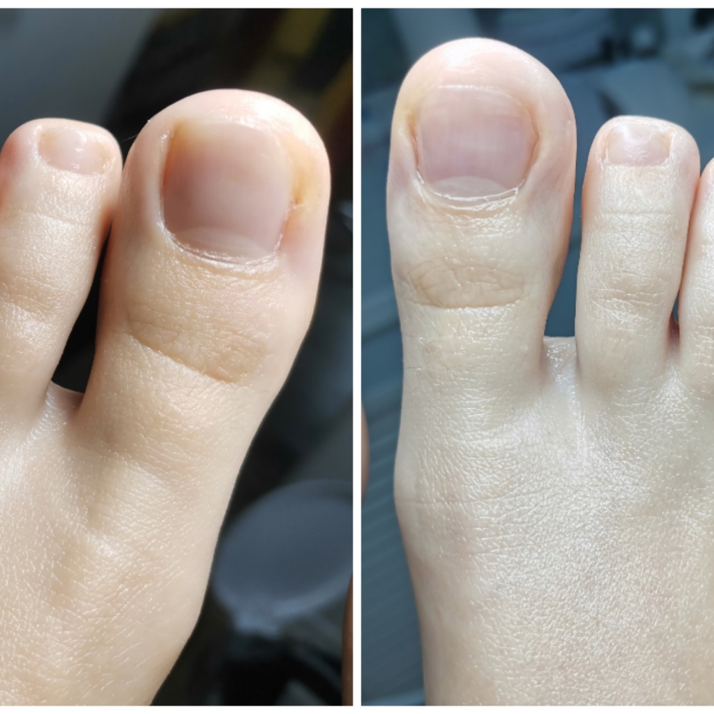 Обработка пальчиков ног