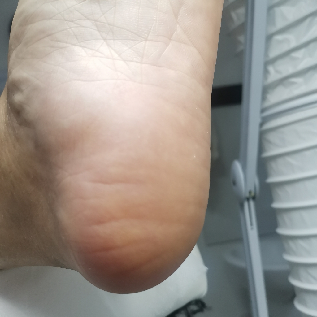 Обработка здоровой стопы