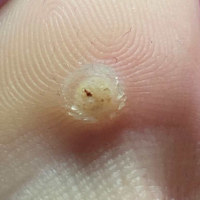 Обработка бородавки