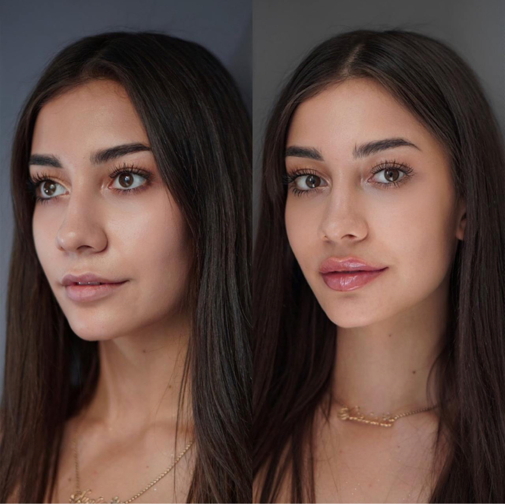 Контурная пластика губ