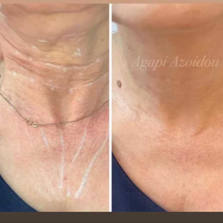 BOTOX NECK- NECKLACE 
Rings of Venus
(Δαχτυλίδια της Αφροδίτης)