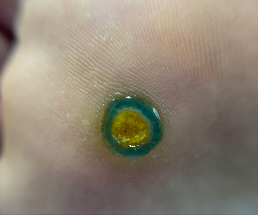 Обработка бородавок (на стопе)