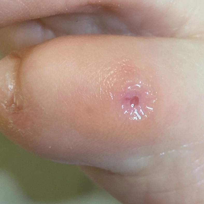 Обработка мозолей  (стержневой / фиброзной)