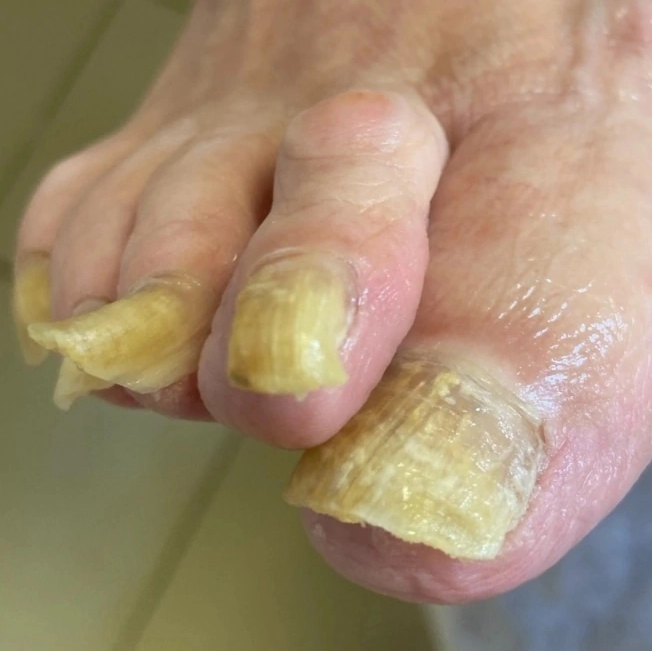 Обработка ногтей с онихогрифозом