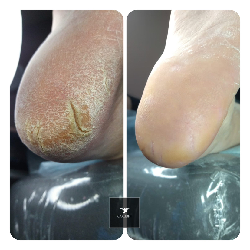 Педикюр сложные стопы