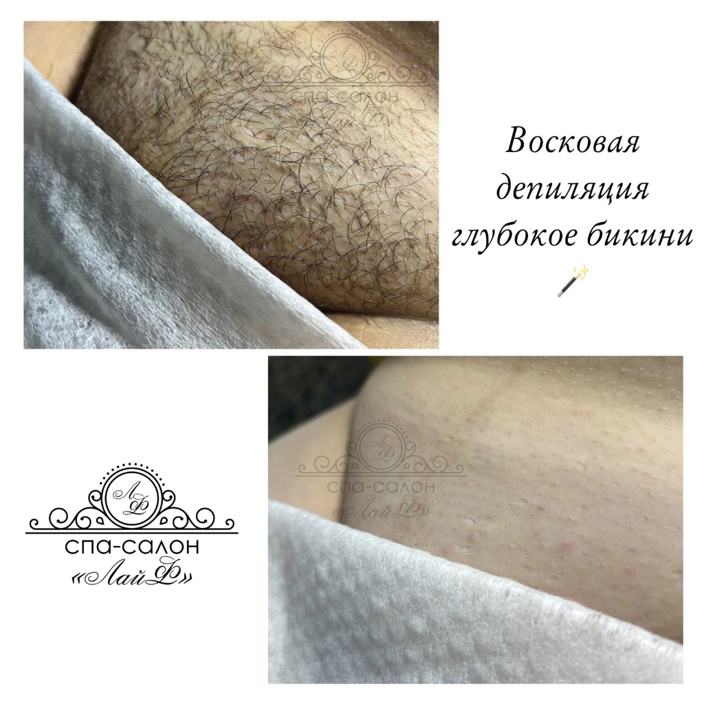Восковая депиляция бикини глубокое