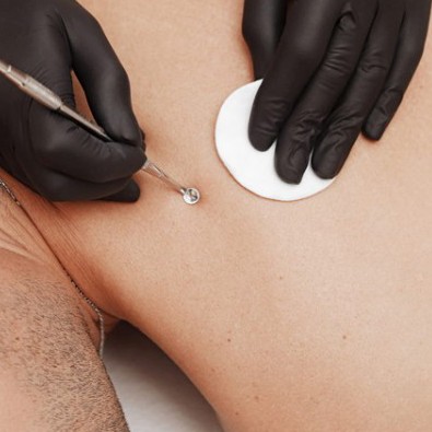 Комплексная чистка спины