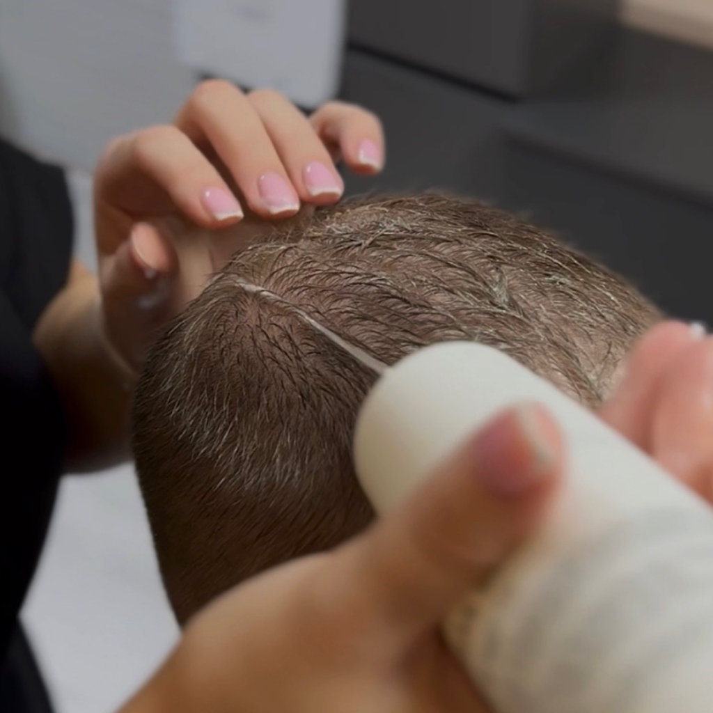 Пилинг кожи головы