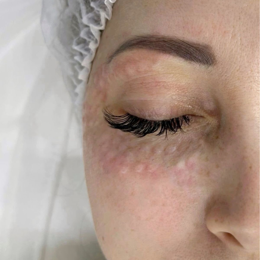 Биоревитализация зоны вокруг глаз