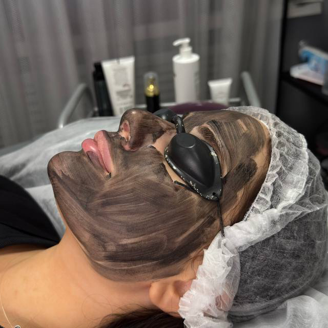 Карбоновый пилинг