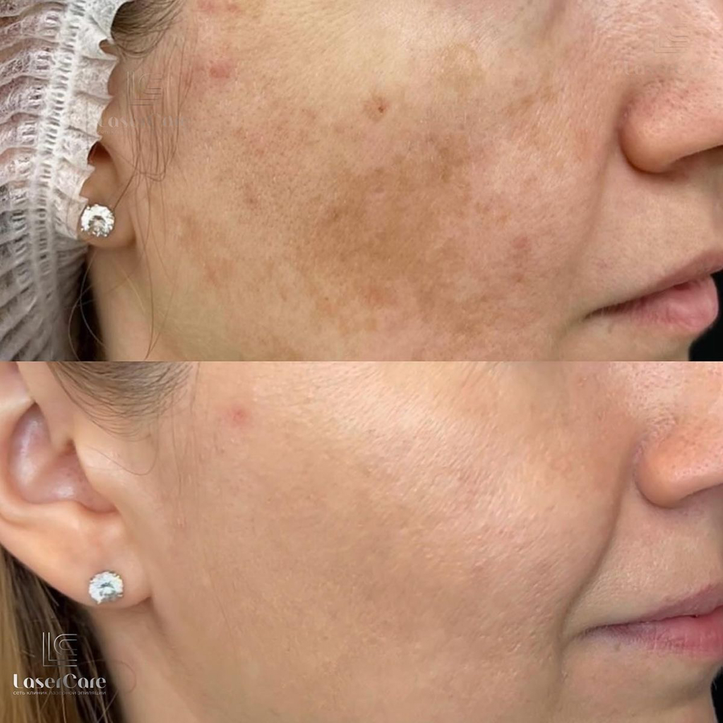 Удаление пигментных пятен лазером