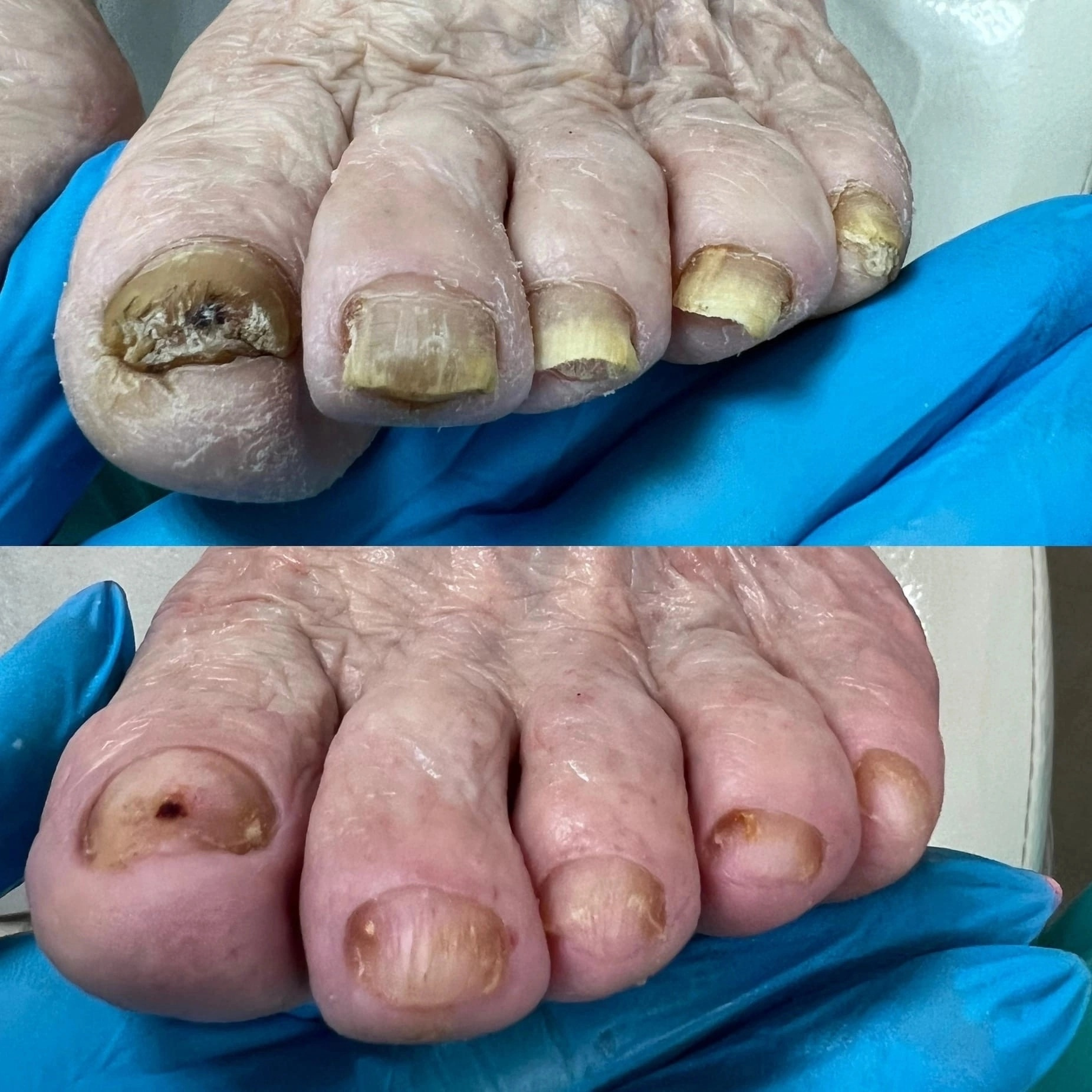 Диабетический педикюр