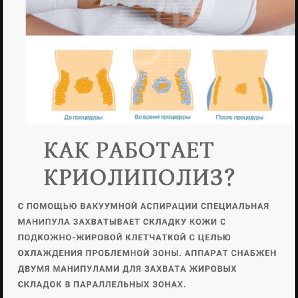 Криолиполиз 1 сеанс 1 зона