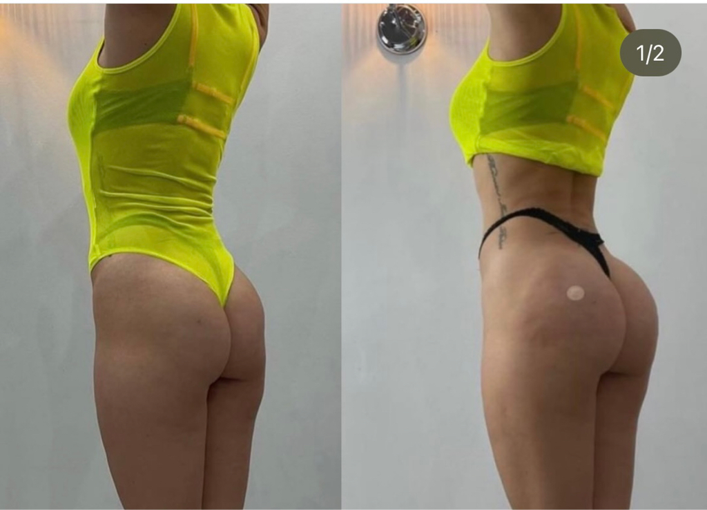 Увеличение ягодиц филлером