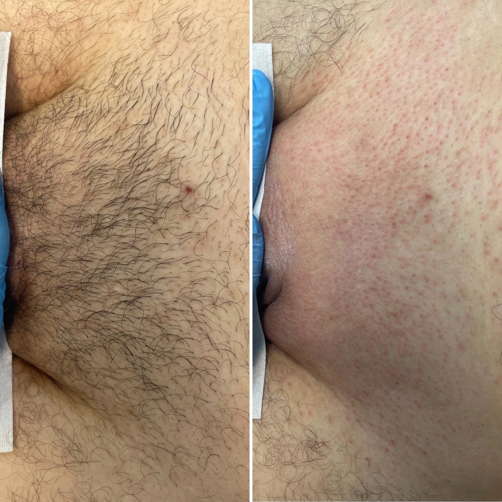 Глубокий пах