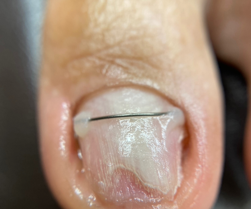 Установка титановой нити  (большой палец)