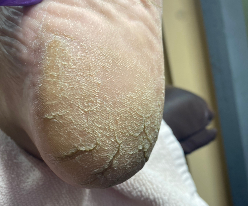 Обработка мозоли/трещины