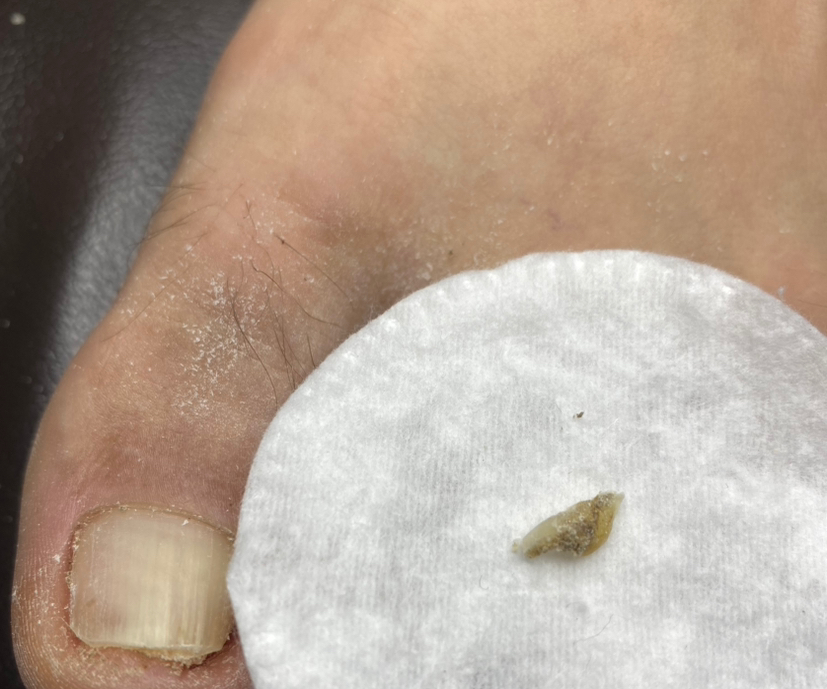 Обработка вросшего ногтя