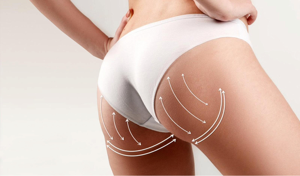 RF-лифтинг ягодицы