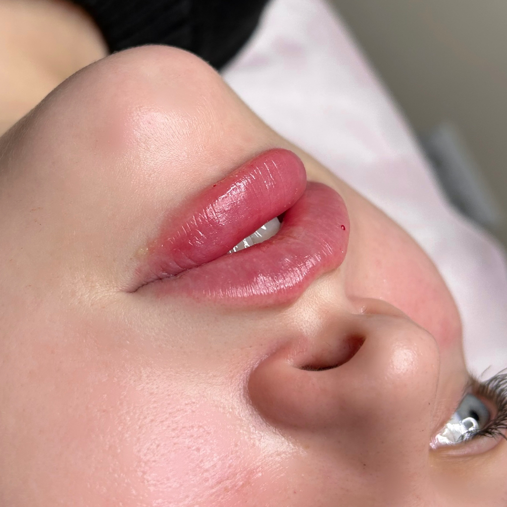 Увеличение губ премиальным препаратом (Швейцария,Франция)