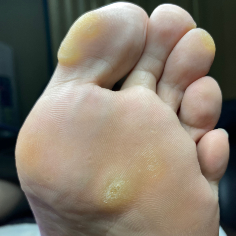 Педикюр обработка проблемных зон