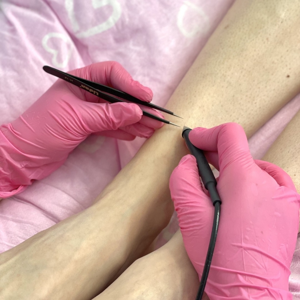 Электроэпиляция 90 минут (1,5 часа)