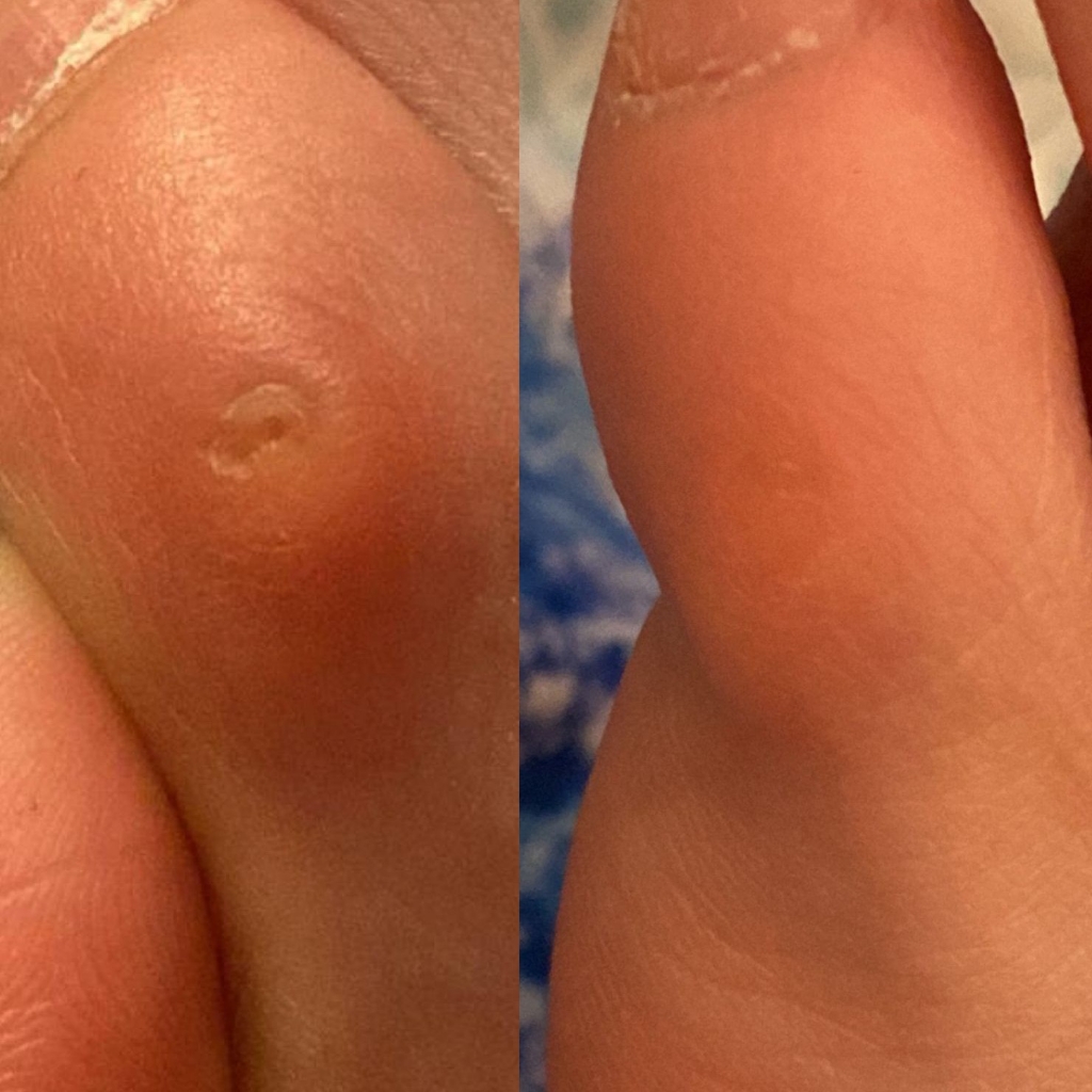 Обработка локальной омозолелости ( с разгрузкой)