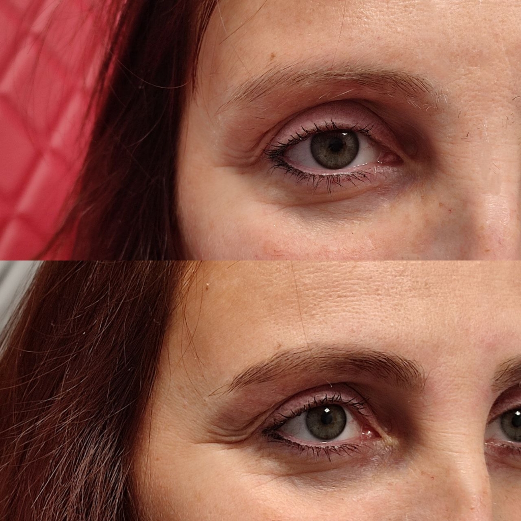 «Счастье для бровей» - ботокс