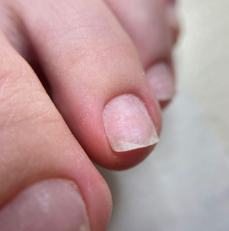 Гигиенический педикюр