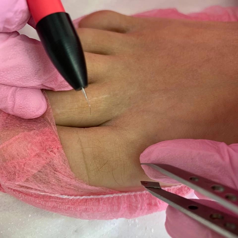 Электроэпиляция зоны голени/бедра