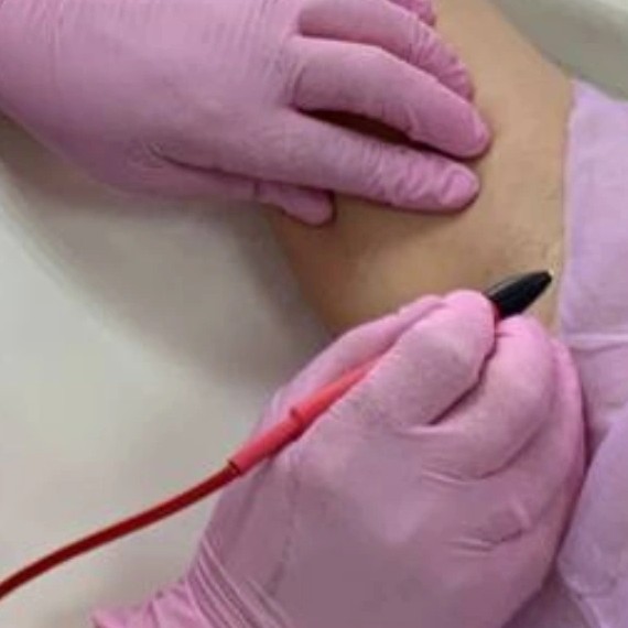 Электроэпиляция зоны подмышек