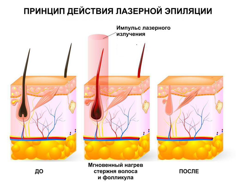 Лазерная эпиляция подмышек