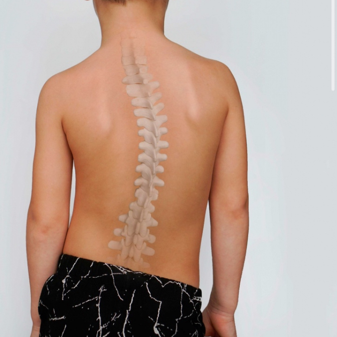 КОМПЛЕКС при СКОЛИОЗЕ  Массаж ( 30 минут)+ АФК ( 30 минут)