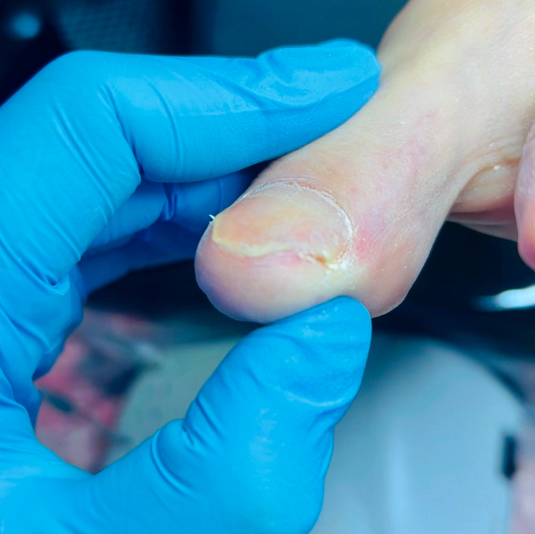 Обработка вросшего ногтя