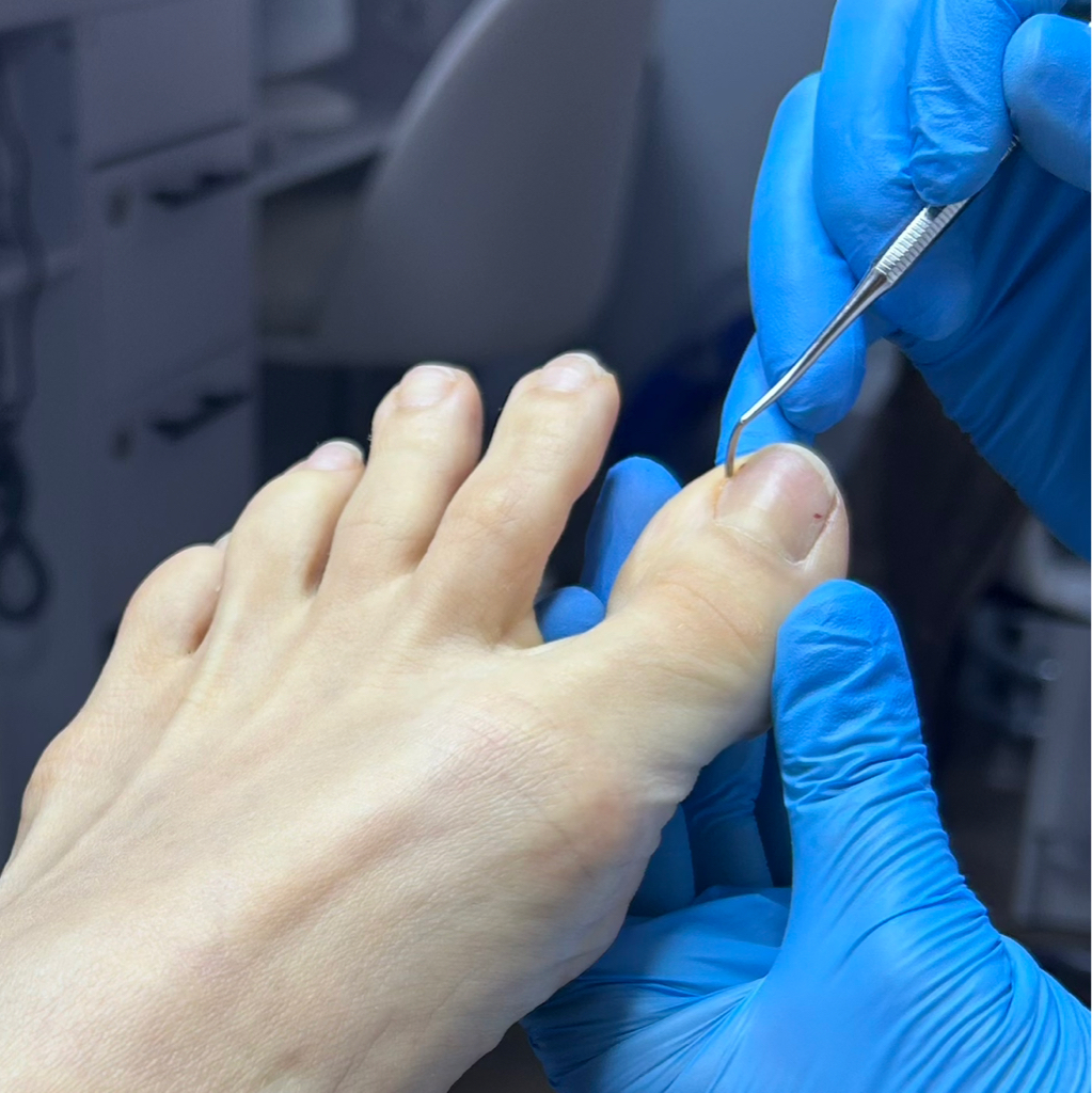 Обработка вросшего ногтя с воспалением