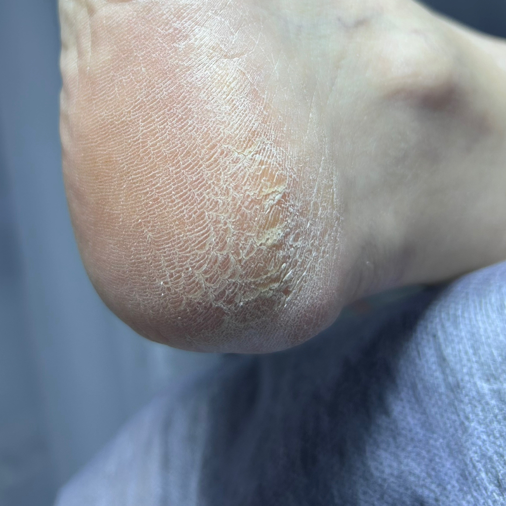 Обработка глубокой трещины